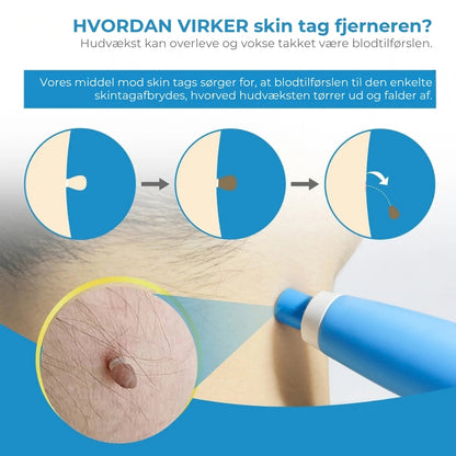 Pen til fjernelse af skin tags