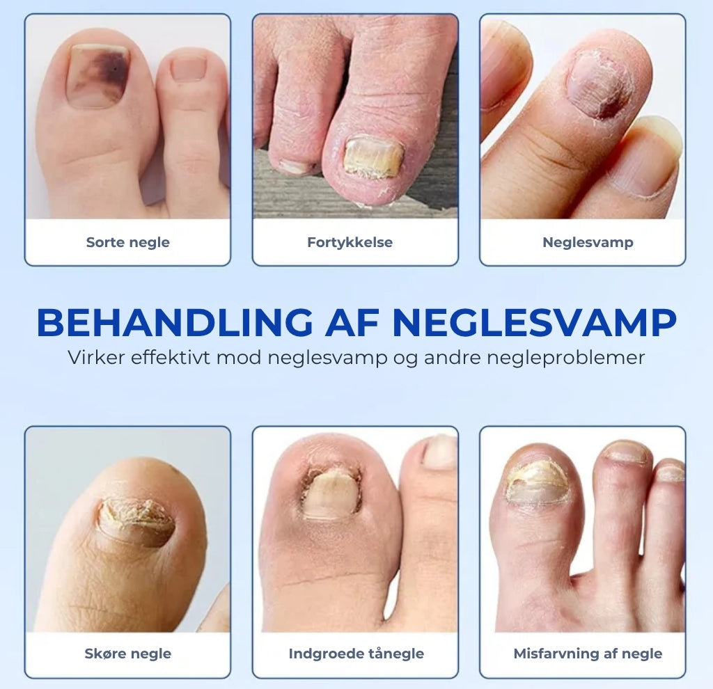 Plaster til behandling af neglesvamp – Hurtigtvirkende behandling for sunde negle