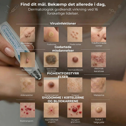 Roll-on til hudvorter og vorter