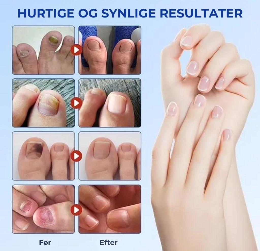 Plaster til behandling af neglesvamp – Hurtigtvirkende behandling for sunde negle
