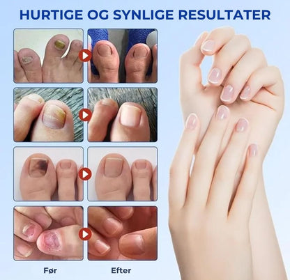 Plaster til behandling af neglesvamp – Hurtigtvirkende behandling for sunde negle